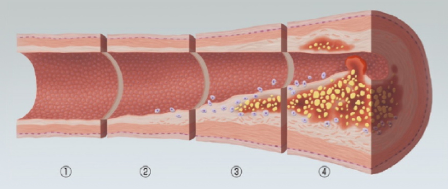 生活習慣病 高脂血症 高コレステロール血症 脂質異常症 医療法人恵山会 丸山病院