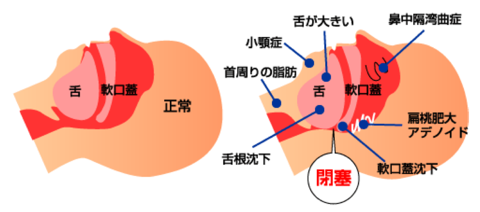 OSAとは何ですか?