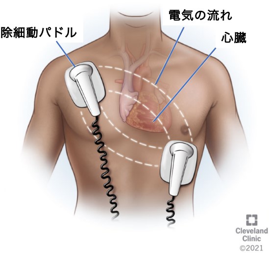 除細動器を使った電気的除細動のイメージ