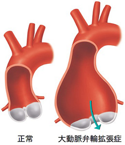 大動脈弁輪拡張症の図
