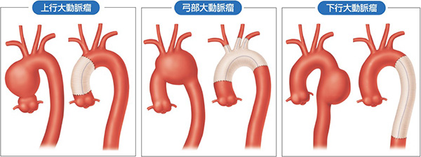 大動脈瘤の術前と人工血管置換術後のイメージ