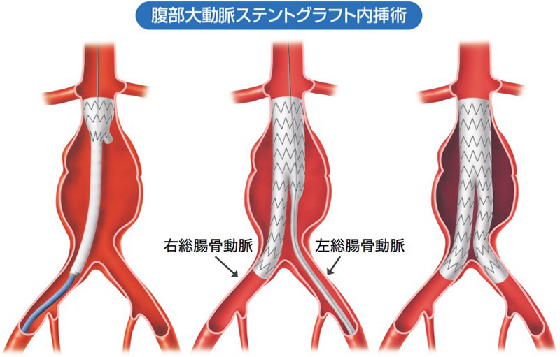 腹部大動脈瘤に対するステントグラフト内挿術イメージ