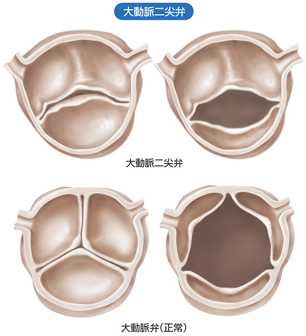 大動脈二尖弁（上段）と正常の大動脈弁（下段）のイメージ