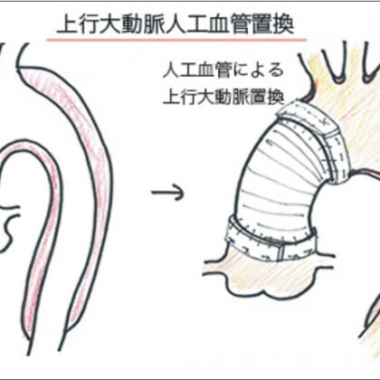 上行大動脈人工血管置換術のイメージ