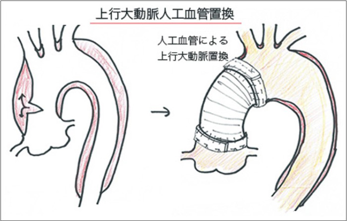 上行大動脈人工血管置換術のイメージ