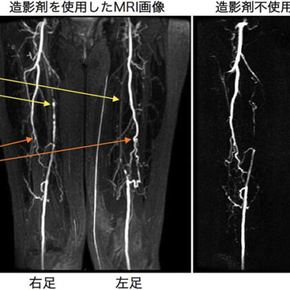 造影MRI比較