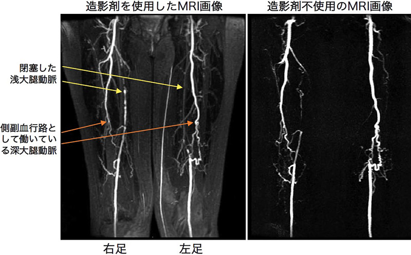 造影MRI比較