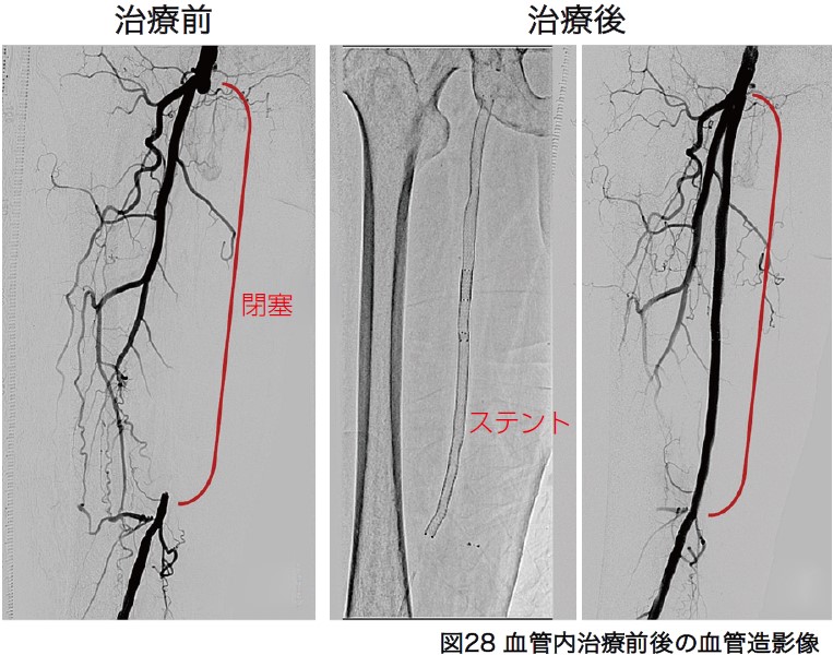 カテーテル治療前後の血管造影