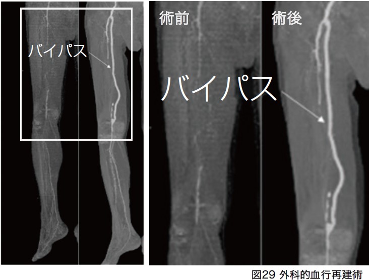 バイパス術前後の血管造影