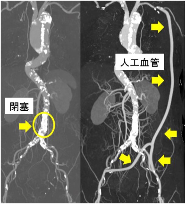 左腋窩動脈CT画像