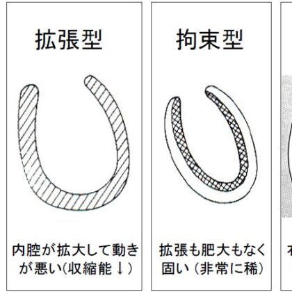 心筋症の５つの病型