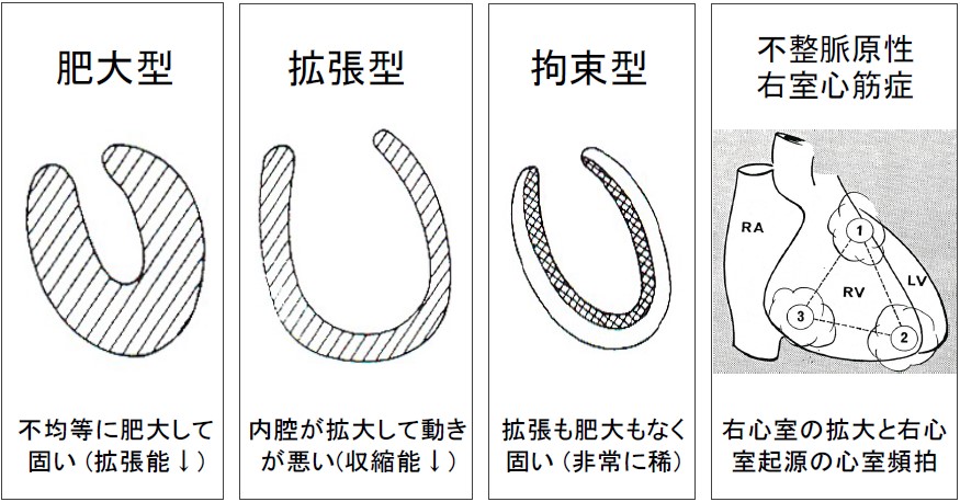 心筋症の５つの病型