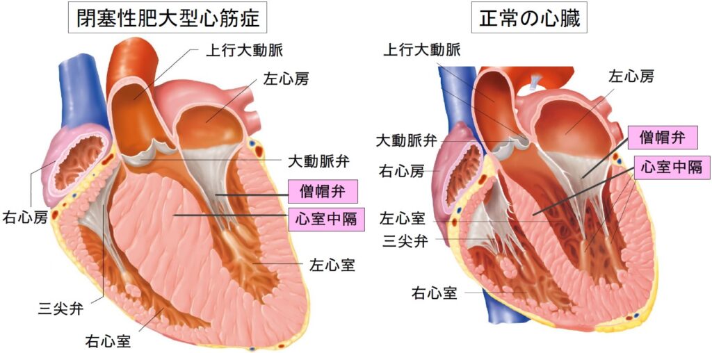 肥大型心筋症(HCM)の心臓と、正常の心臓のイメージ