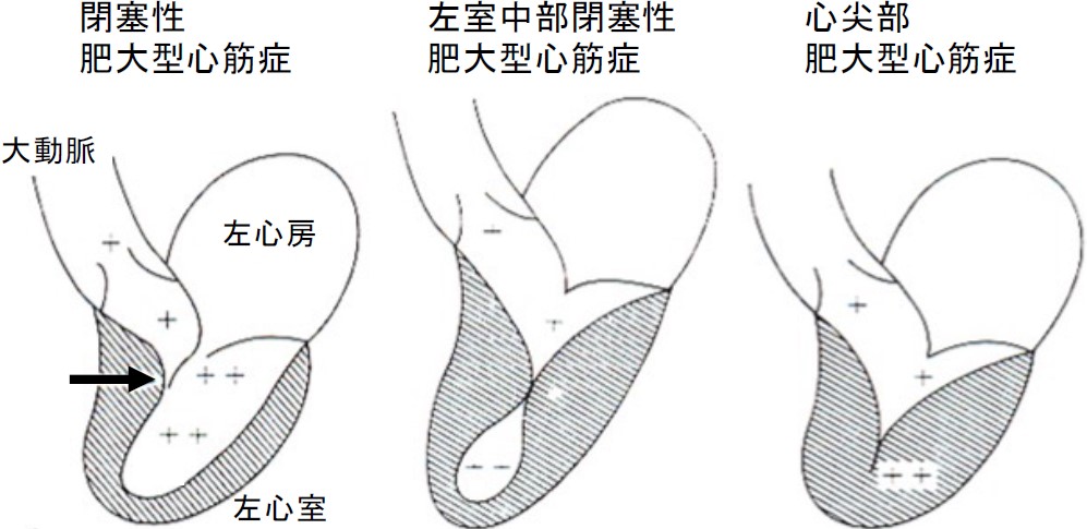 心筋症イメージ
