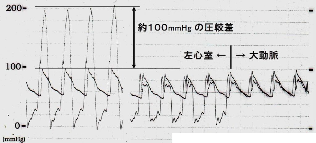 閉塞性肥大型心筋症の心臓カテーテル検査(自験例)