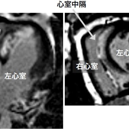 閉塞性肥大型心筋症の心臓カテーテル検査（自験例）